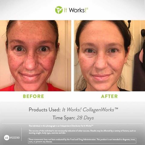 collagenworks résultats avant après visage it works