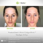 collagenworks résultats avant après visage it works
